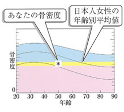 骨密度測定